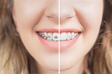 How Witching Smile Teeth Braces Can Correct Bite Issues